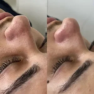 Limpeza de Pele 1
