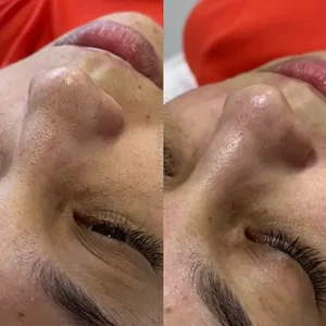 Limpeza de Pele 2