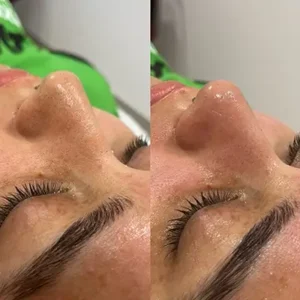 Limpeza de Pele 3