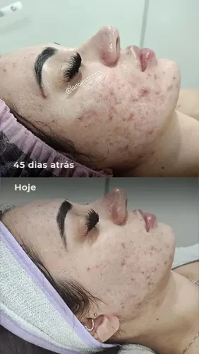 Tratamento de Acne